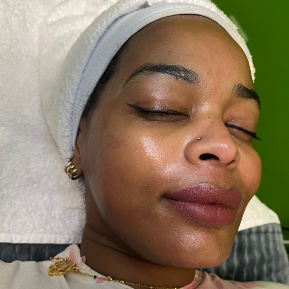 PDRN (Salmon DNA) Microneedling at Genesis Health and Beauty Bar in Daphne, AL