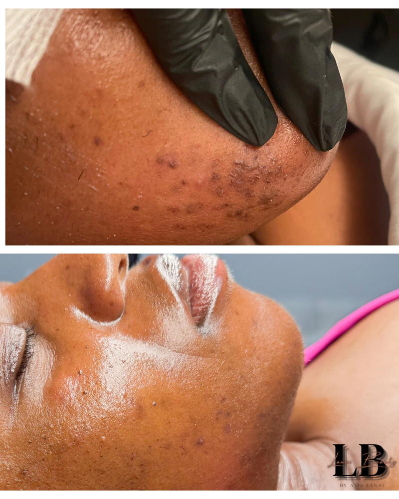 Microdermabrasion