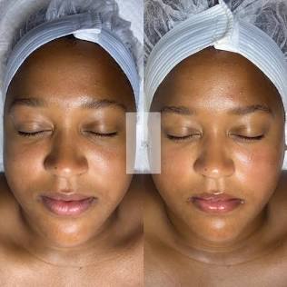 Face Sculpting and Massage