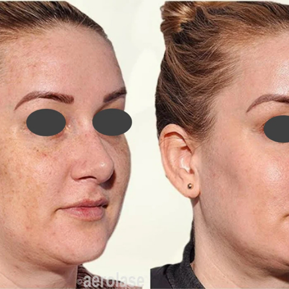 Aerolase Melasma/ Hyperpigmentation at Beauty Skin and Laser Studio in Hauppague, NY