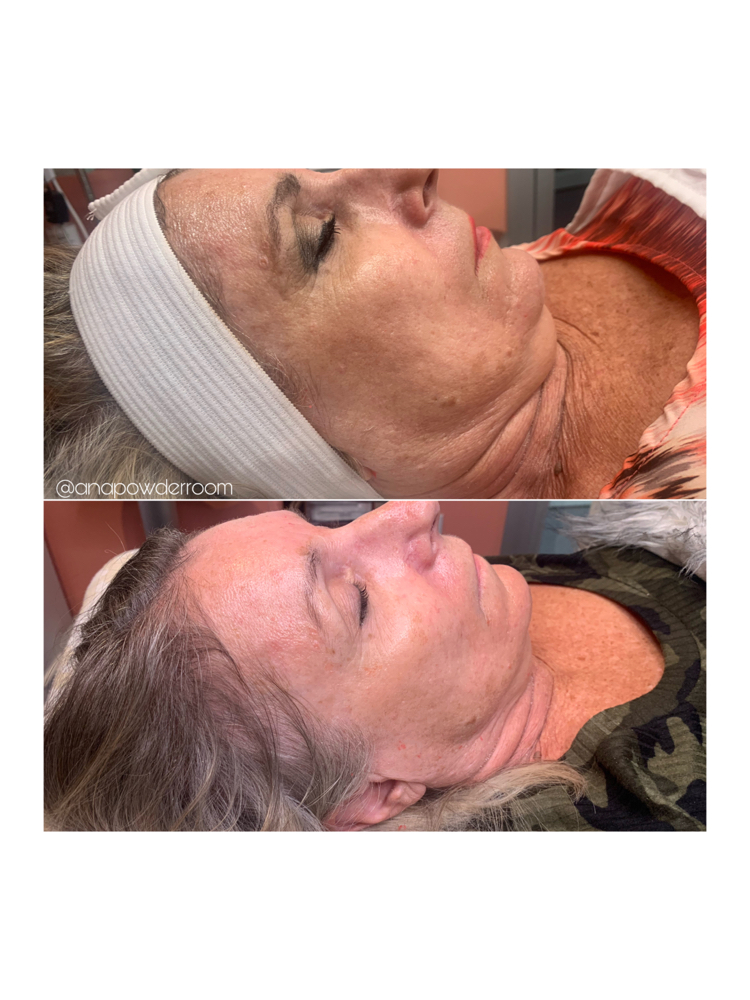 Microneedling