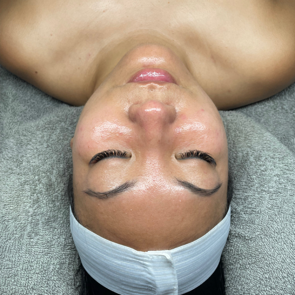 Microneedling Or Chemical Peel at Truly Regal in White Plains, NY