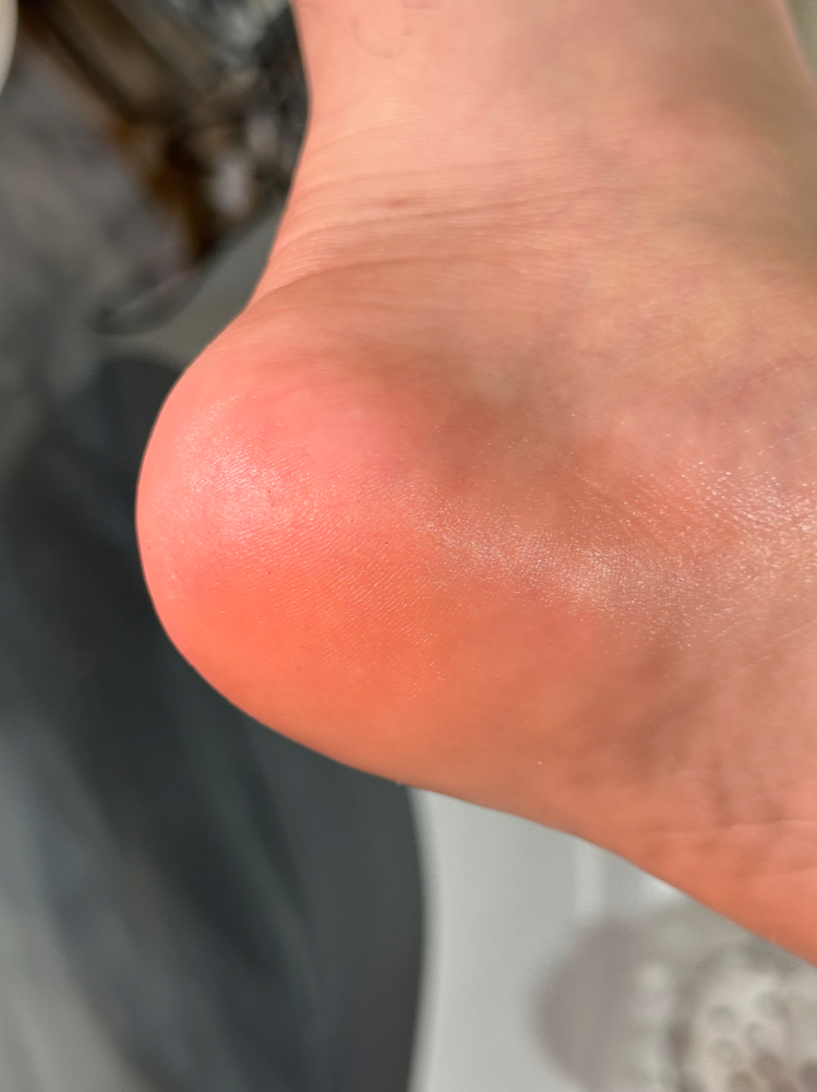 Callus Remover