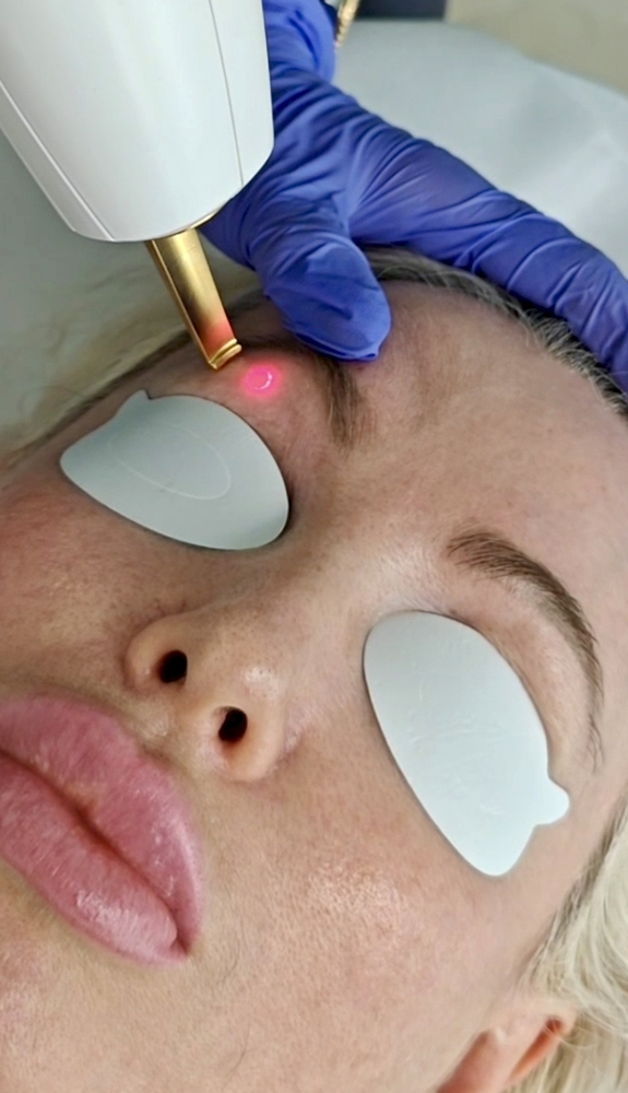 Eyelid rejuvenation