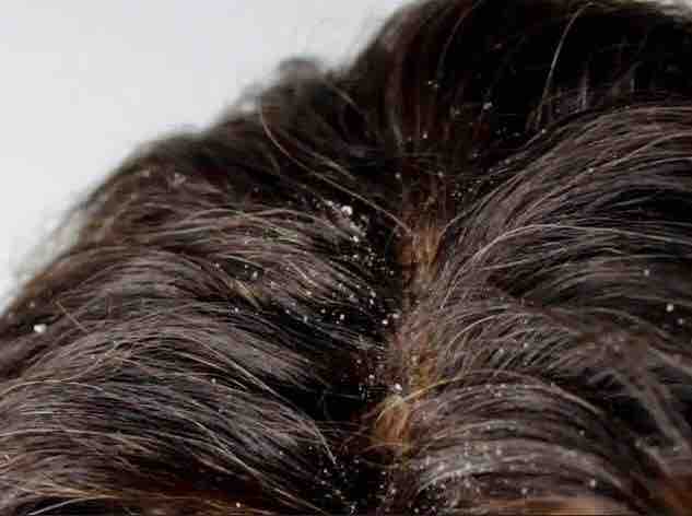 Scalp Therapy Treatment