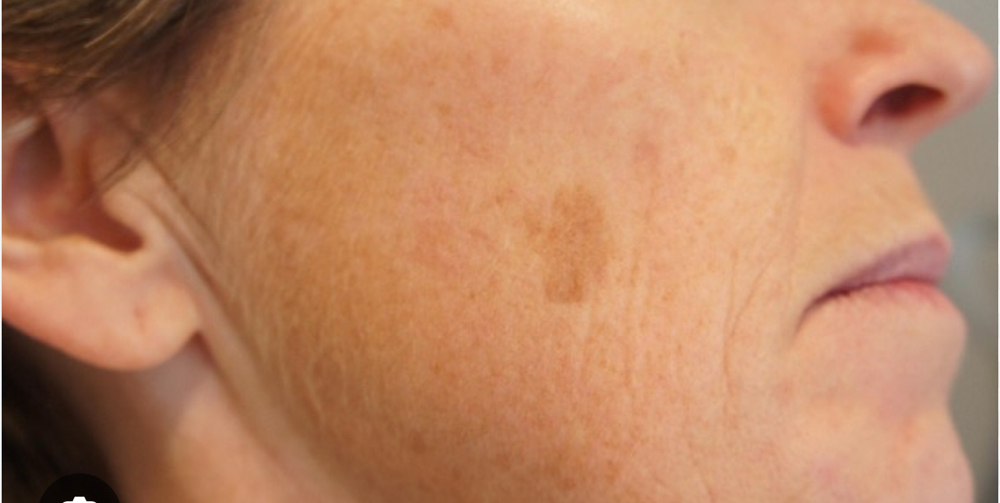 Spot Treatment TCA