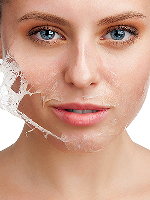 Chemical Peeling