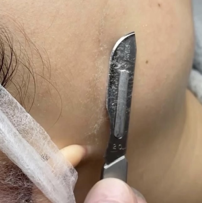 Dermaplaning Facial