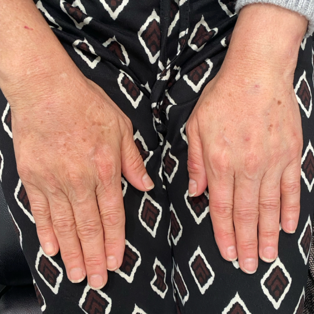 Hand rejuvenation at Aesthetic NP Marie in Portland, OR