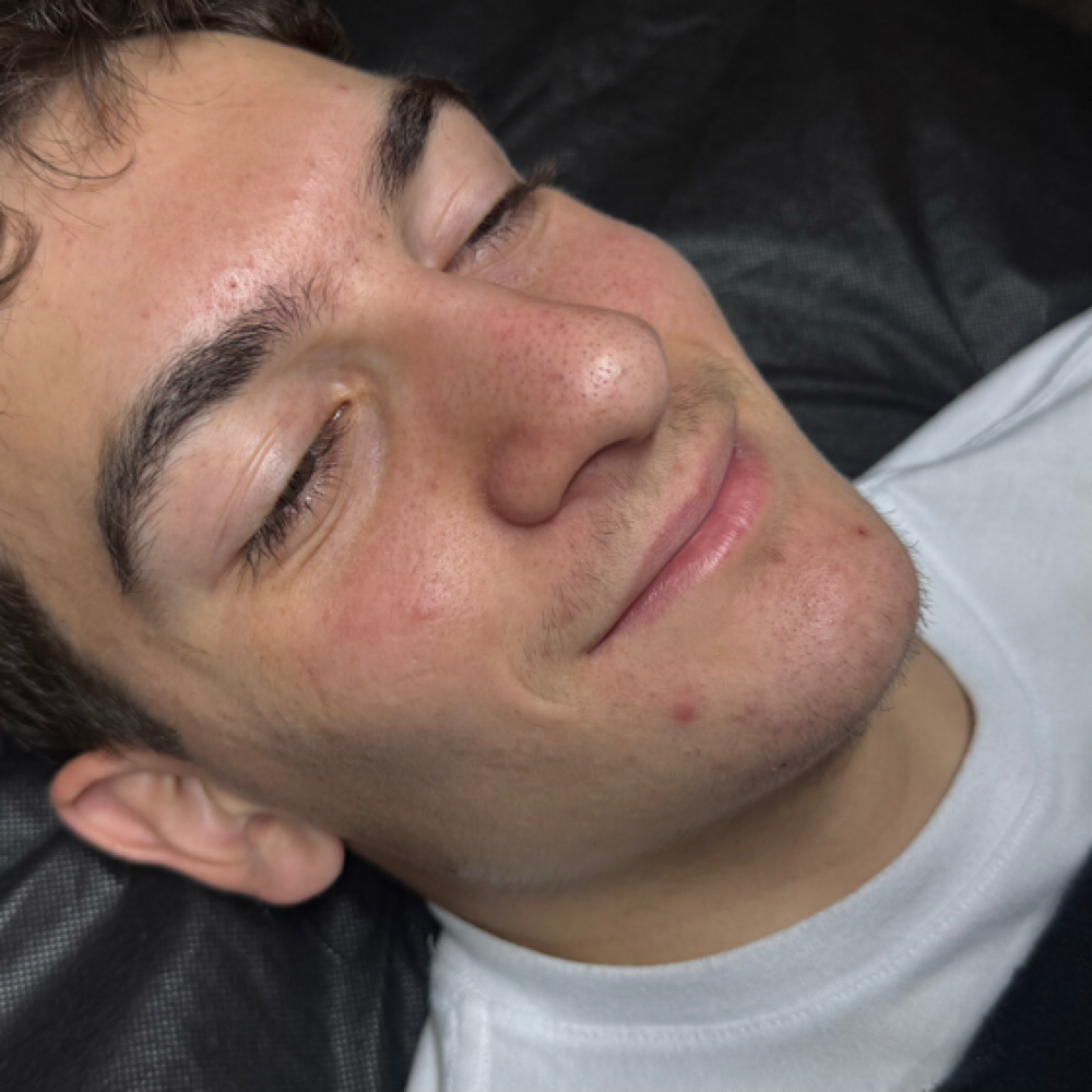 Acne Clearing Teen Facial at Elite Esthetic Lounge in Manalapan, NJ