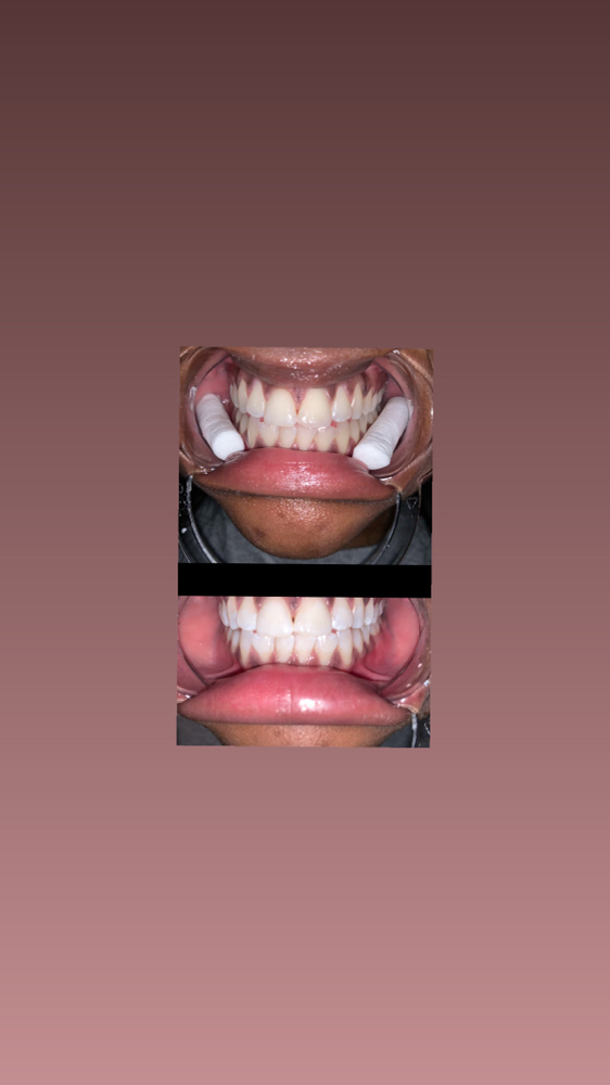 teeth whitening 1hr at RJ Cosmetics in PONTOTOC, MS
