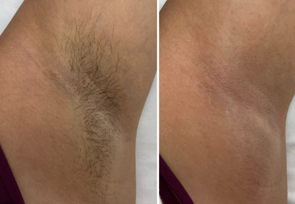 Underarm wax at BEAUTYNESS LOUNGE in Aurora, CO