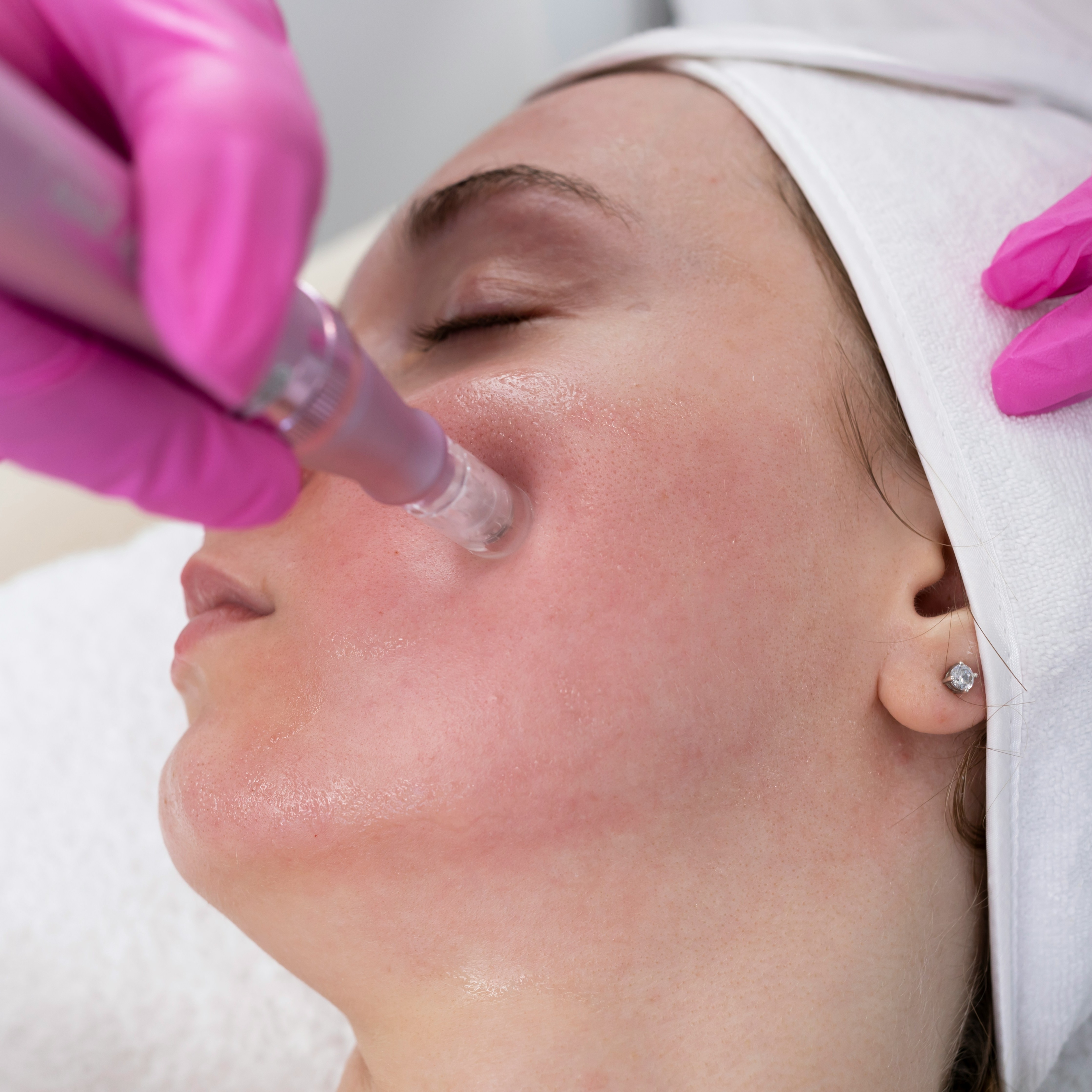 Microneedling at Living Waters Renewal in Colorado Springs, CO
