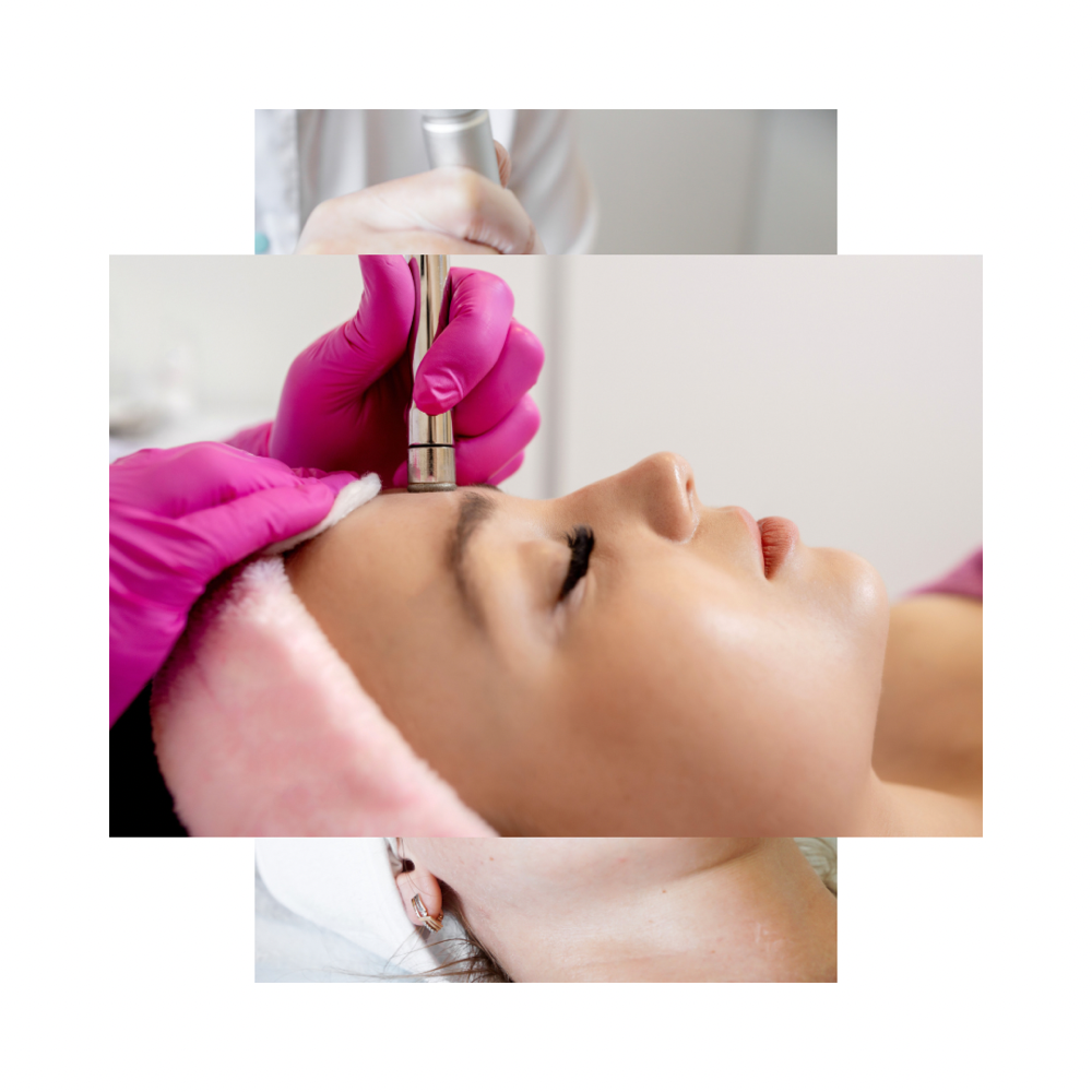 Microdermabrasion Add On