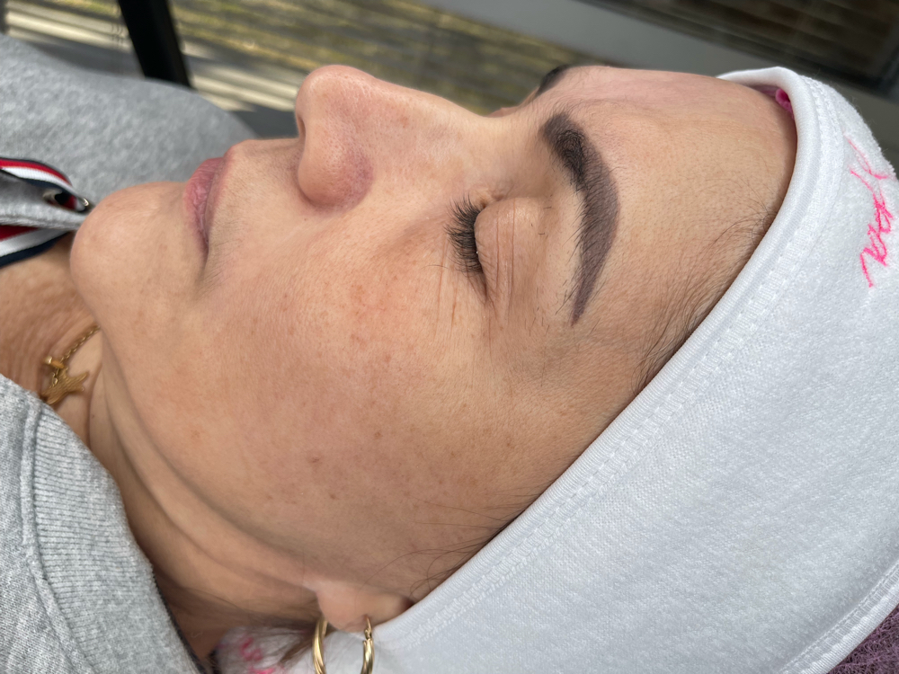 Microneedling