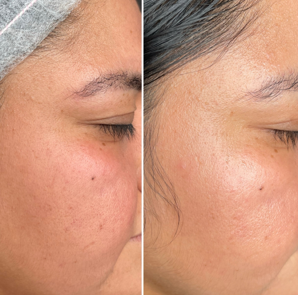 Lightenning Treatment at Mimi Beauty Spa in Dallas, TX