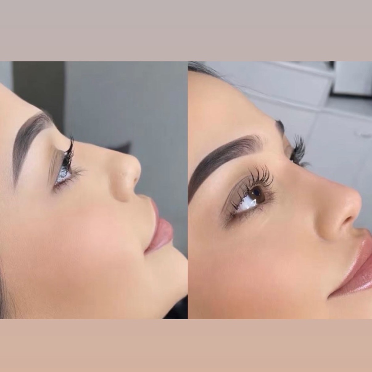 Filler Nose at Gold Stone Beauty in mcallen, TX