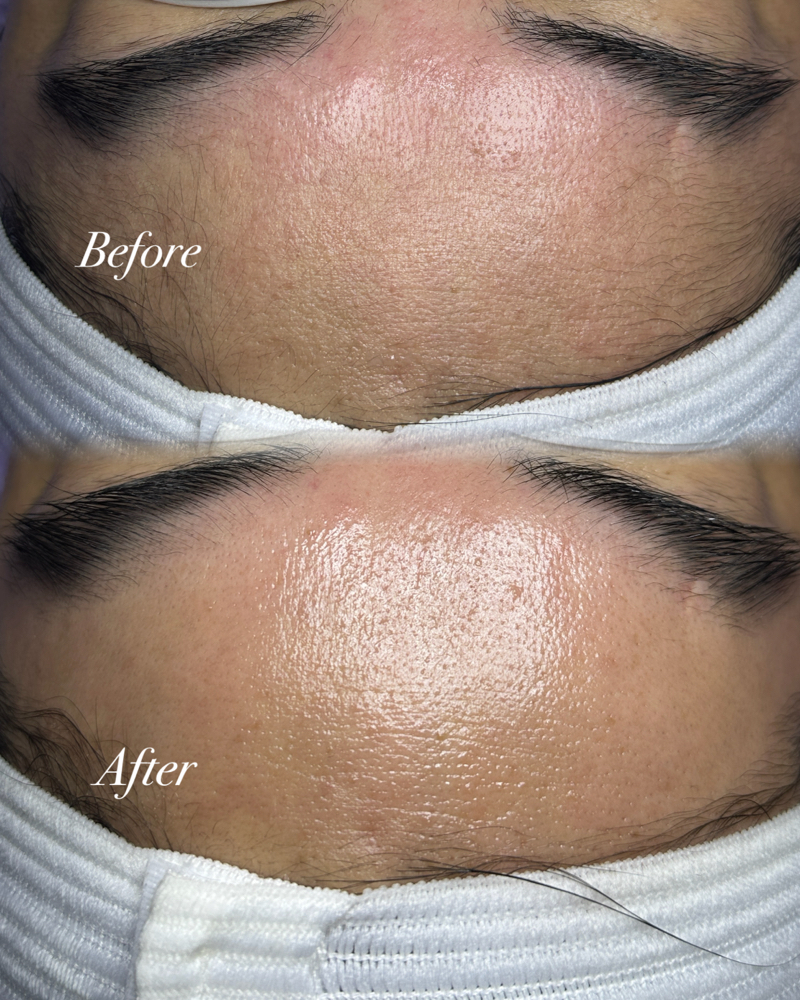 HydroGlow + Dermaplane Combo