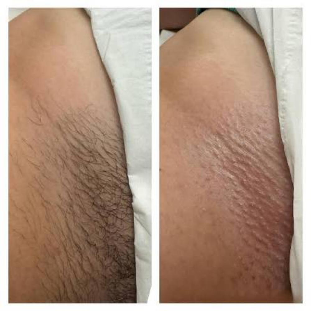 Bikini Wax Series (3) at HCesthetics in Fort Branch, IN