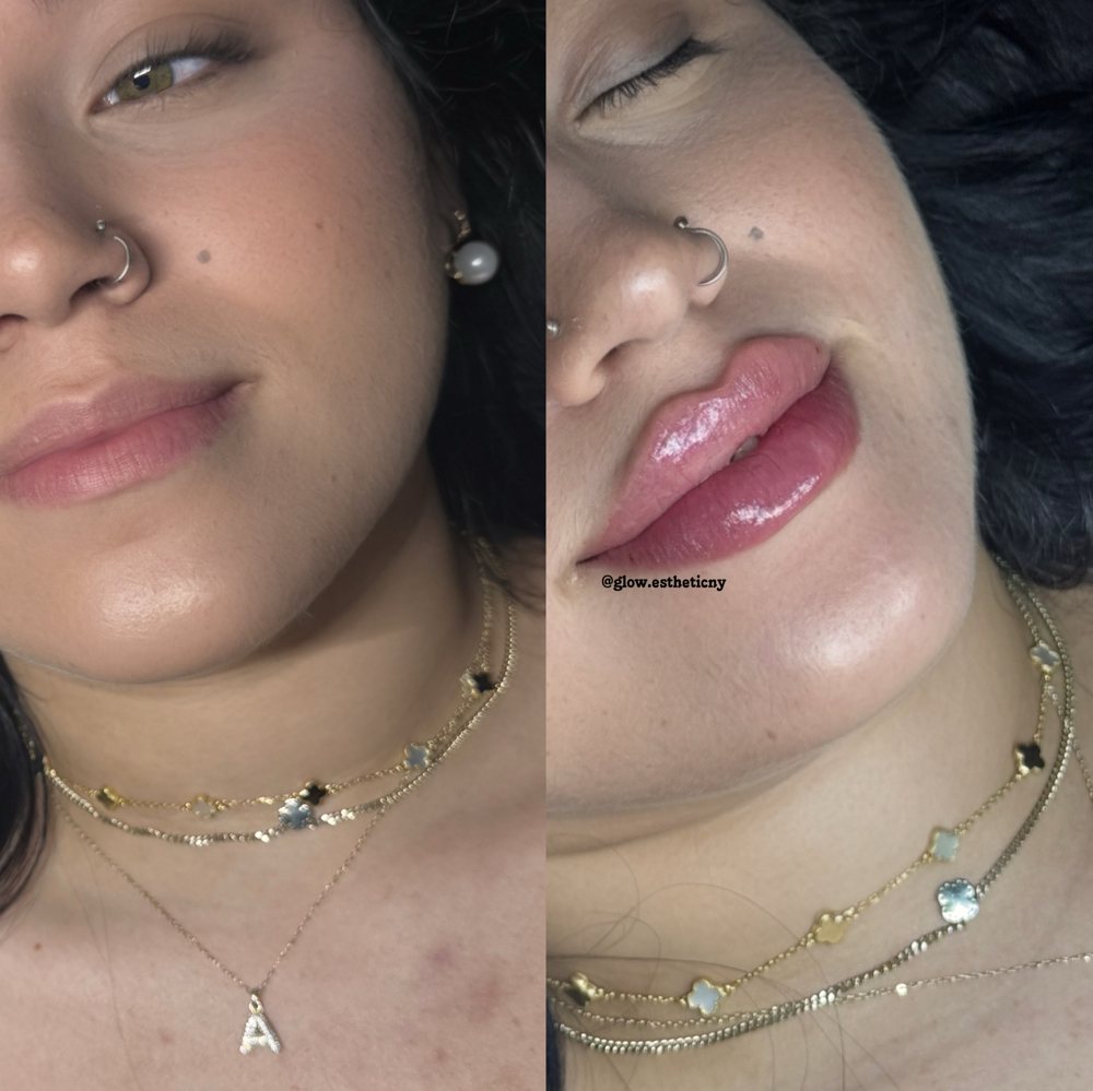 Lip Filler 1ML Full Syringe