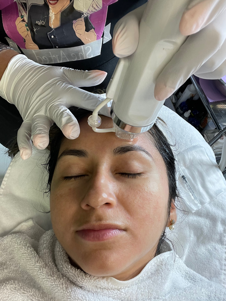 RF Microneedling