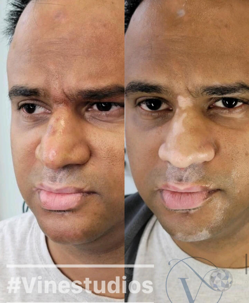 Medium area- Vitiligo camp at VINE Studios Permanent Cosmetics in Maple Valley Wa, WA