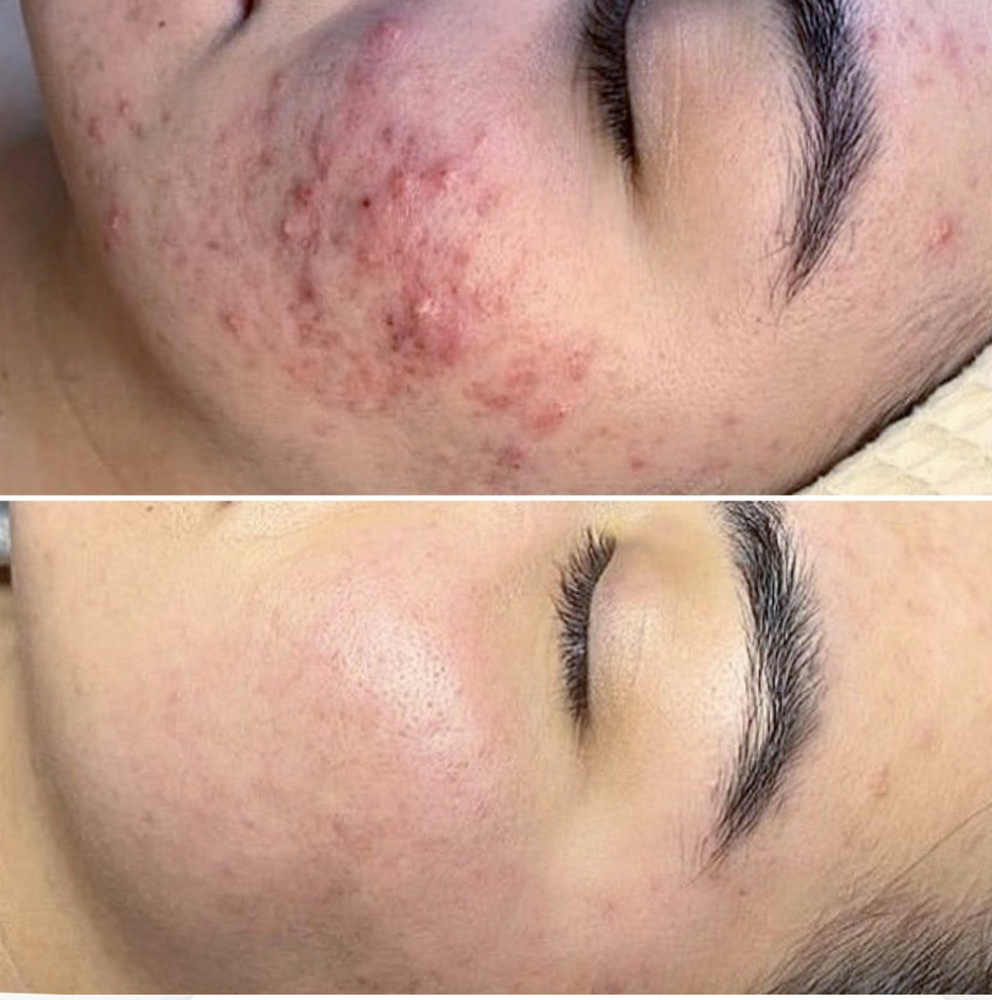 Skin Reset Bundle 8 sessions