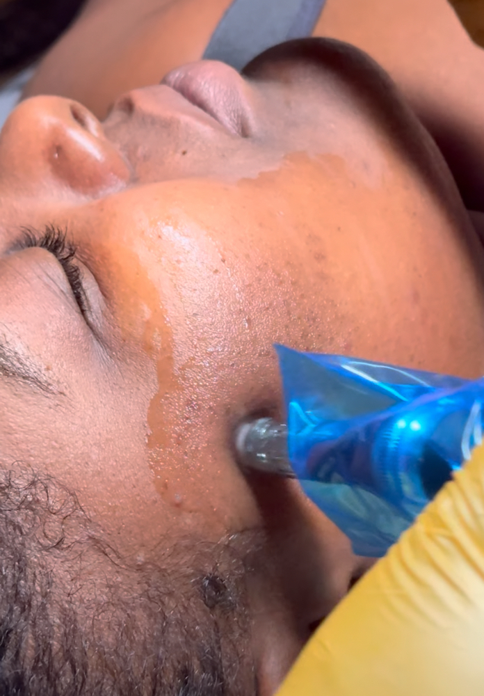 Microneedling