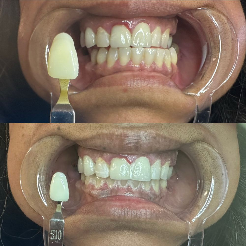 1 Hour Teeth Whitening Session