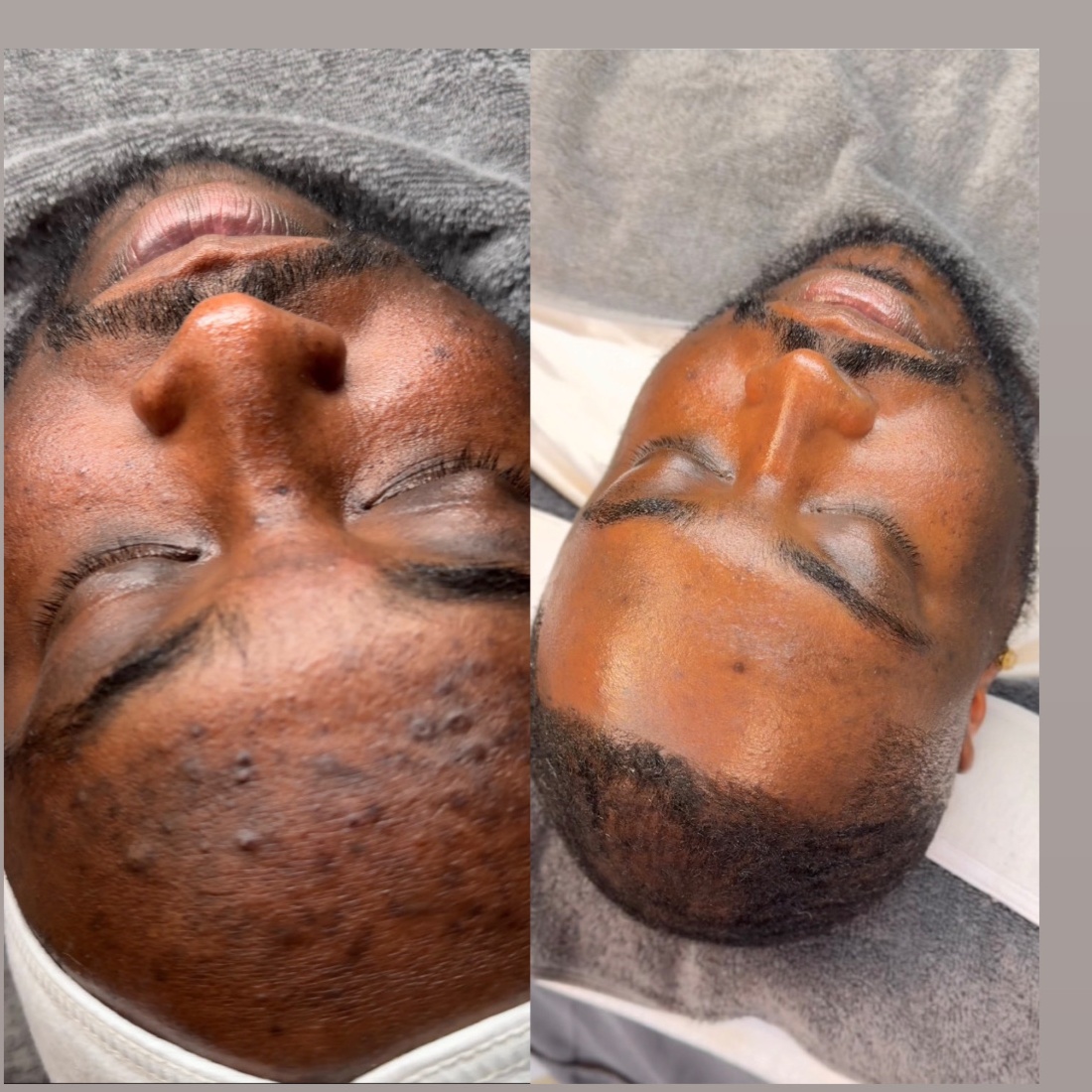 HYPERPIGMENTATION BOOTCAMP at Beautiquè by Blanche in Charlotte, NC