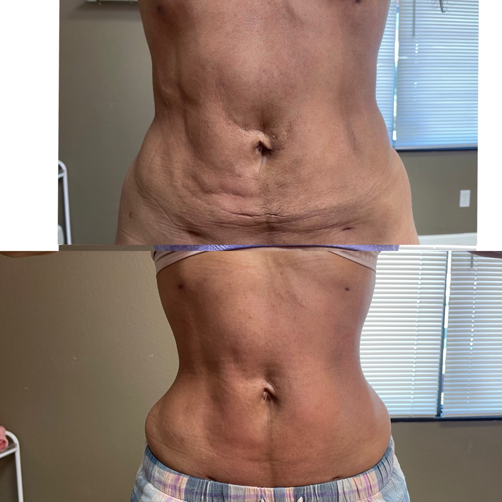 Post Op (More than 4+ weeks healed)