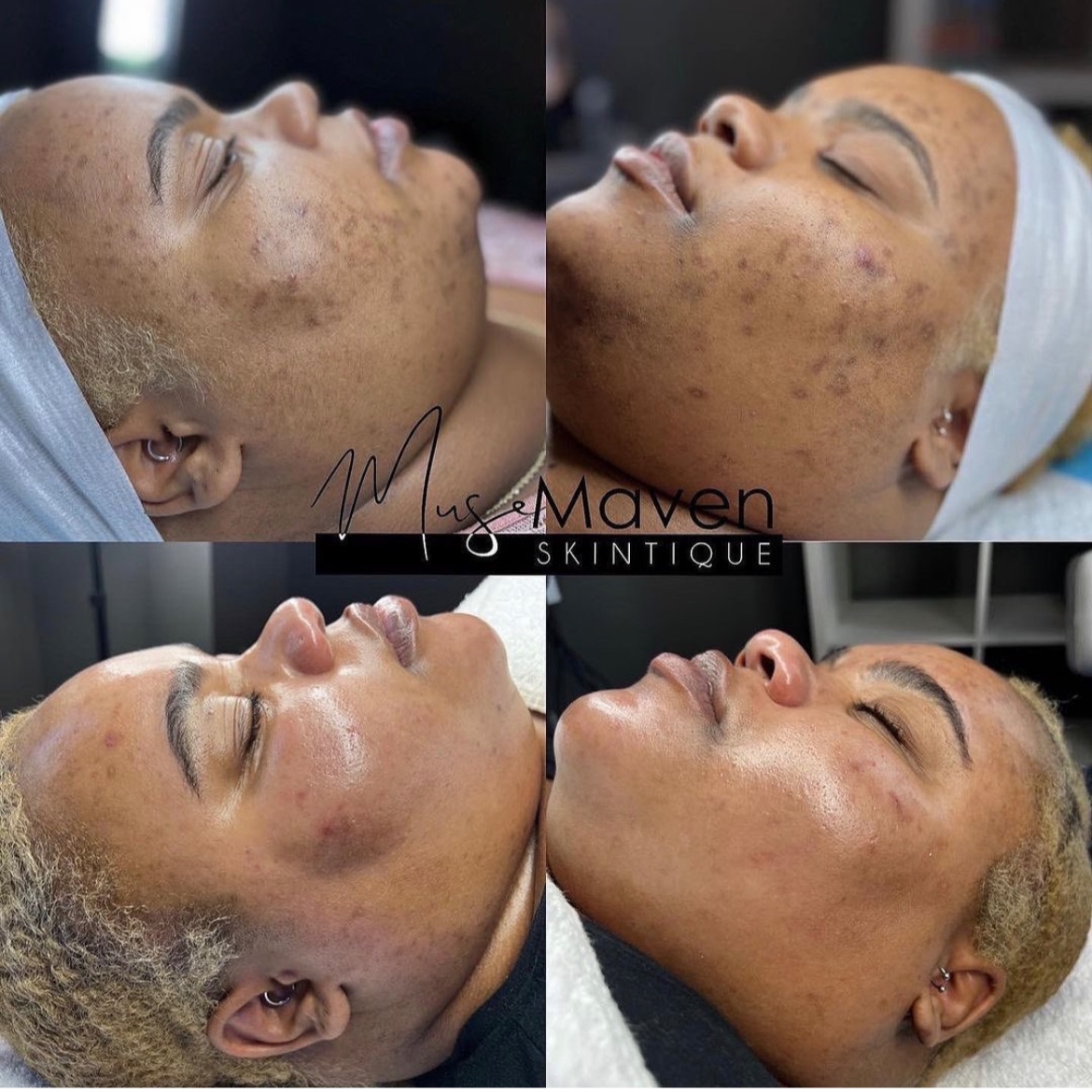 LEVEL 3 CHEMICAL PEEL at MUSE MAVEN SKINTIQUE AND WELLNESS in Atlanta, GA