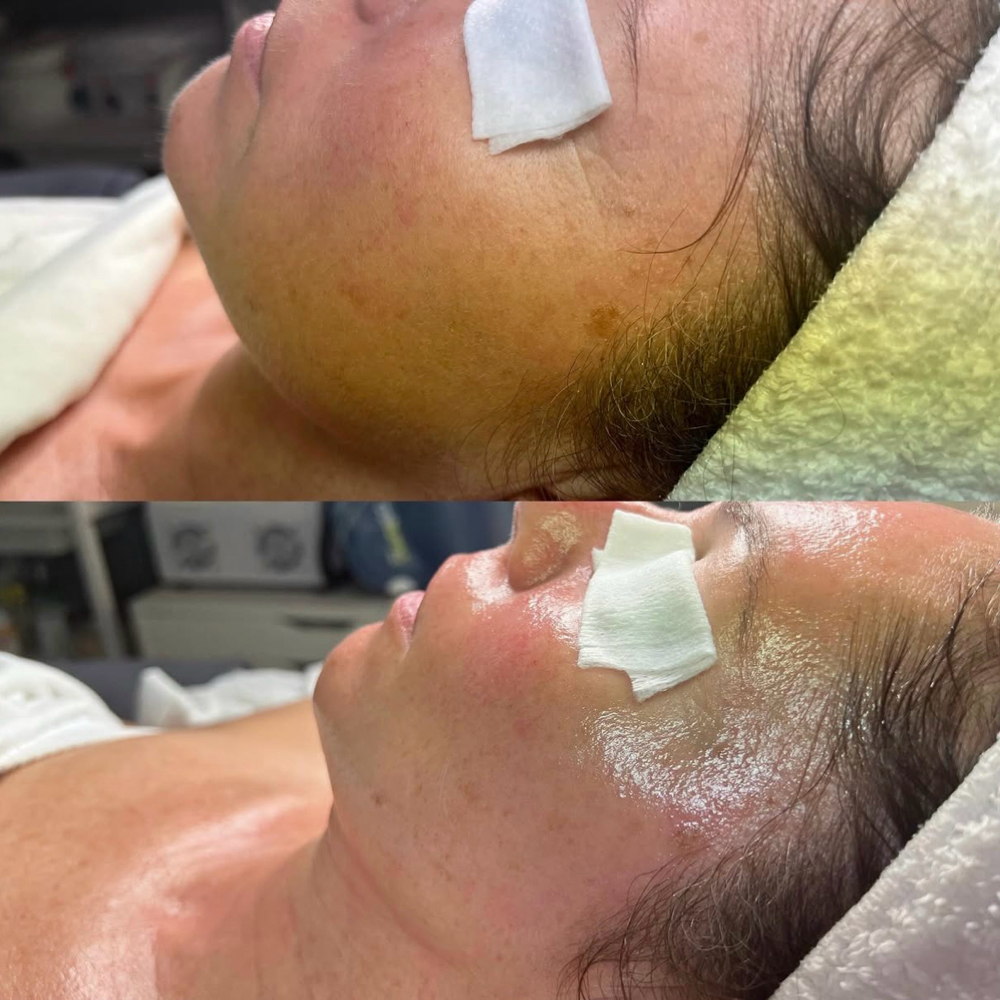 Deluxe HydraFacial at SKIN by Christine Russell in Green Bay, WI