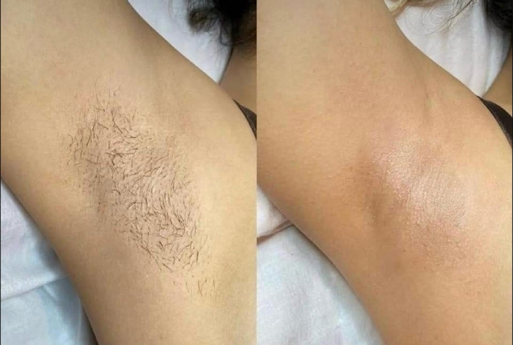 Underarms