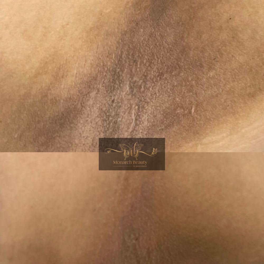 Intimate Lightening 1 Treatment