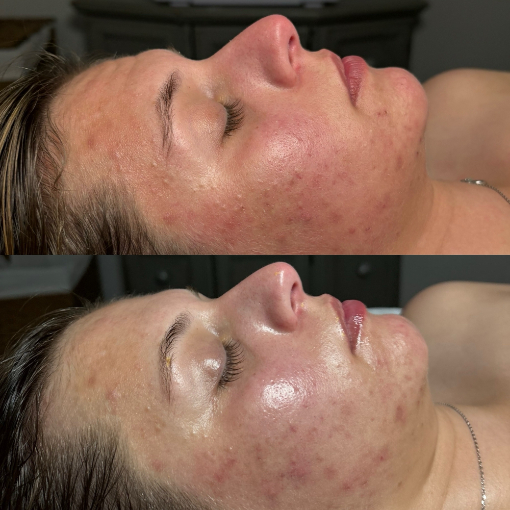 Lightening Lift Peel at Farah Elexis Billiot in Houma, LA