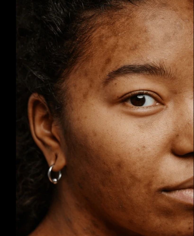 Pigment Peel at Signature Skin Spa in Scottsdale, AZ