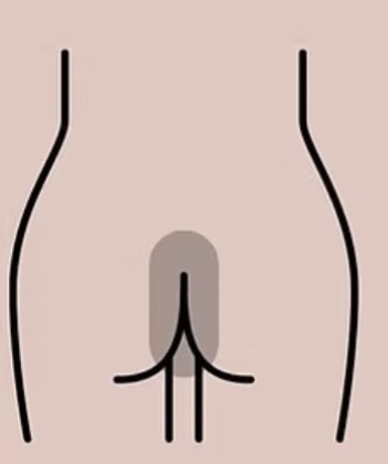 Butt Line Treatment