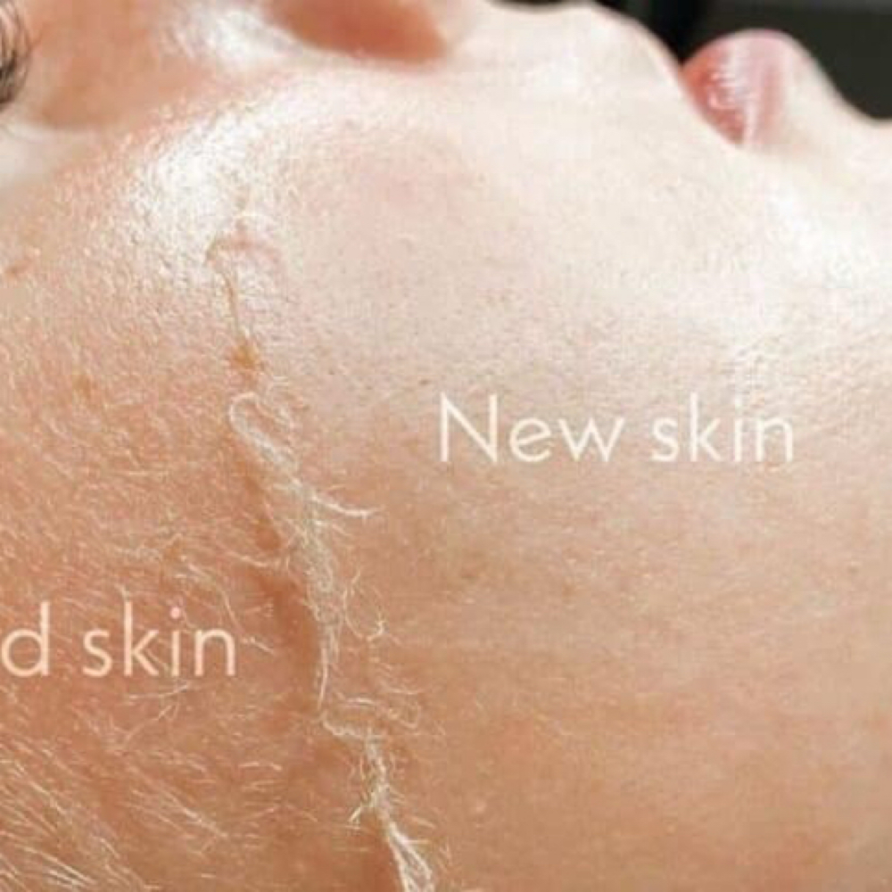 Dermaplane Facial at Allure Aesthetics & Wellness Studio in Midwest City, OK