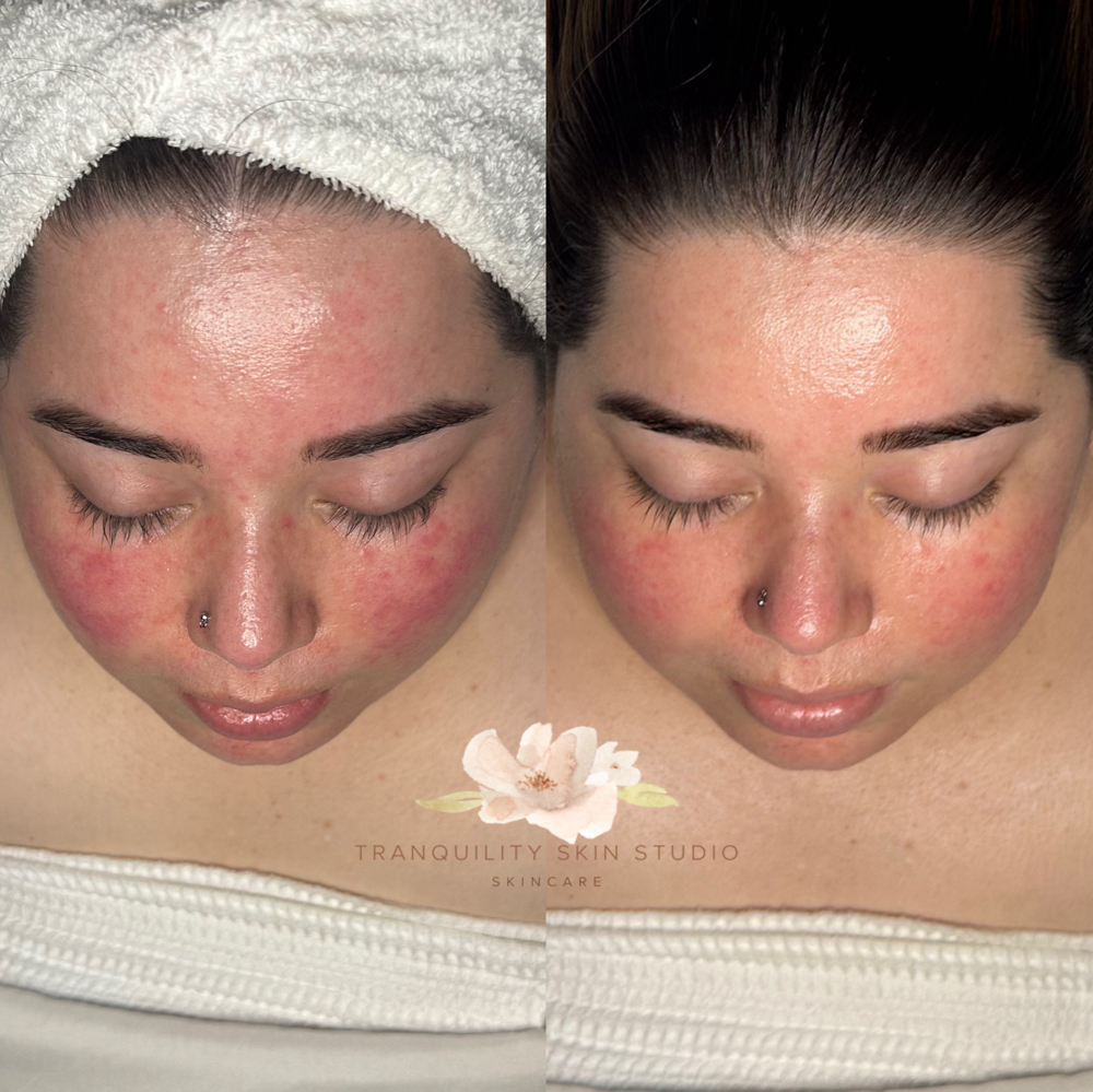 Sensitive/Rosacea Facial