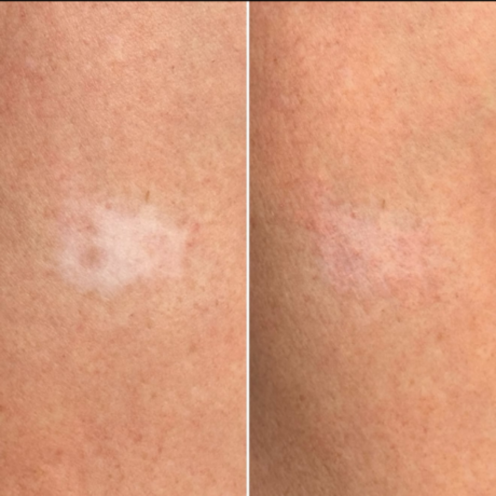 Scar Tattoo Concealment at J Brows Beauty in Coeur d’Alene, ID