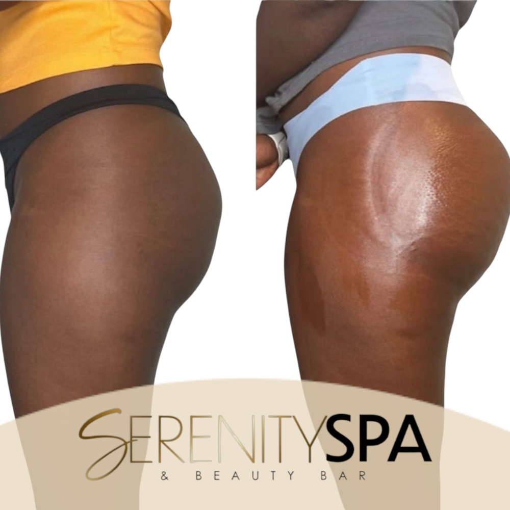 ✨ BBL/Hip Enhancement Combo at Serenity Spa & Beauty Bar in Warwick, RI