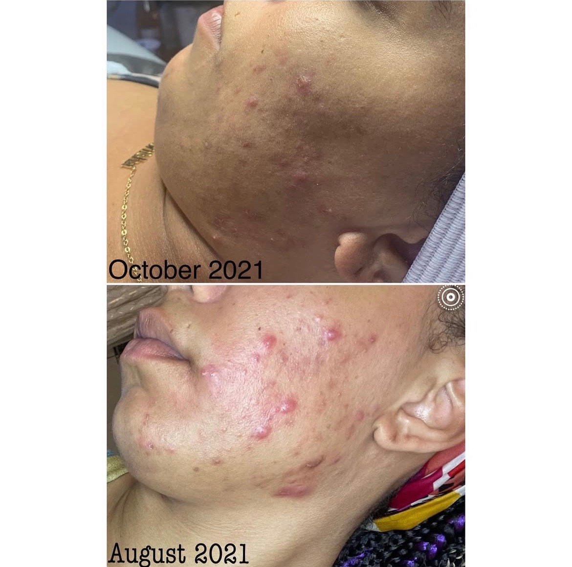 Acne Facial