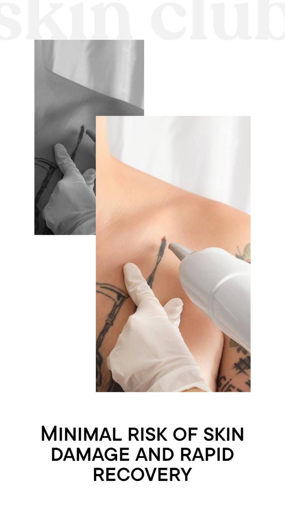 Tattoo Removal