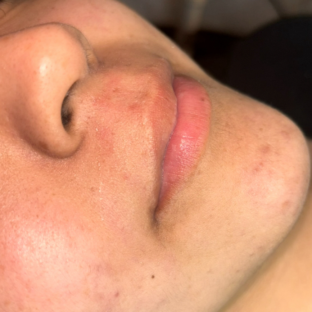 Upper Lip Wax at Pearly Derm in Sun valley, CA