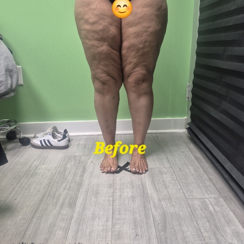 🔹 VARICOSE VEIN–SAFE LEG REDUCTION at JUST BEAUTIFUL SKIN in Goose Creek, SC