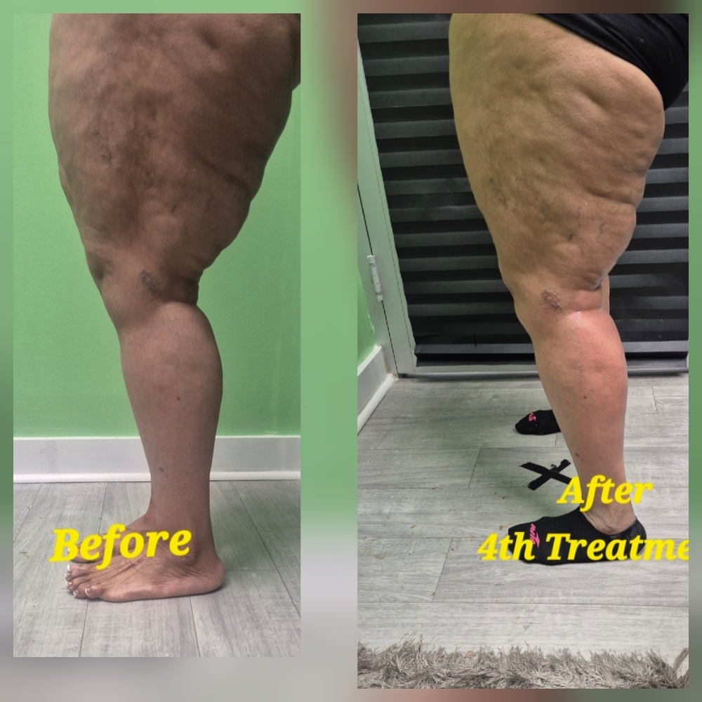 ⭐ Leg Sculpting & Contouring at JUST BEAUTIFUL SKIN in Goose Creek, SC