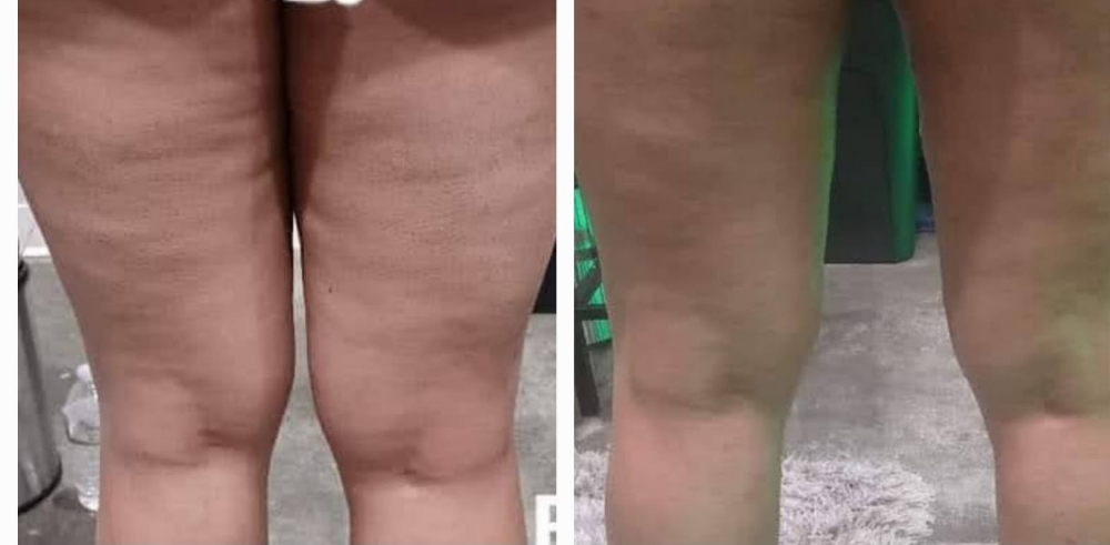 3 Sessions /Smooth & Sculpt Celluli