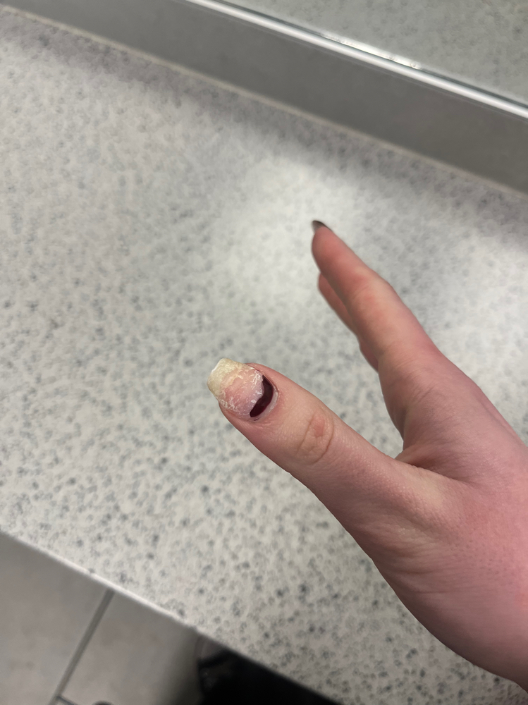Broken nail