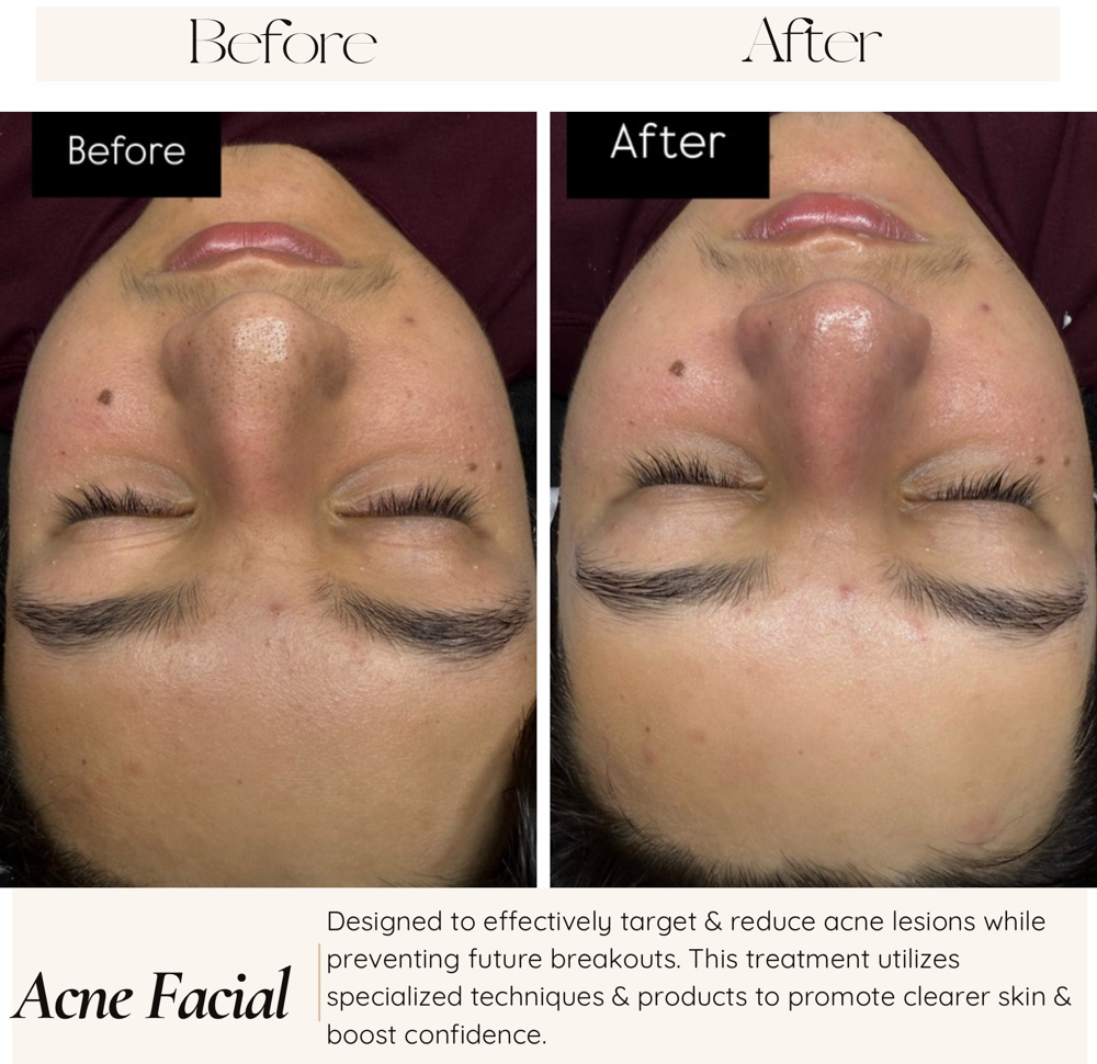 Acne Facial ❤️‍🩹